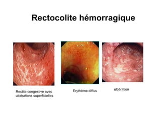 Rectocolite hémorragique




                             Erythème diffus   ulcération
Rectite congestive avec
ulcérations superficielles
 