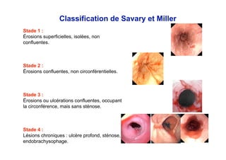 Classification de Savary et Miller
Stade 1 :
Érosions superficielles, isolées, non
confluentes.



Stade 2 :
Érosions confluentes, non circonférentielles.



Stade 3 :
Érosions ou ulcérations confluentes, occupant
la circonférence, mais sans sténose.



Stade 4 :
Lésions chroniques : ulcère profond, sténose,
endobrachysophage.
 