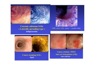 Coecum: adénome 0-IIa
                               ADK colon 0-IIc zoom + crystal violet
« Laterally spreading type »
        indigocarmin




                                     Cancer estomac 0-II b
    Cancer œsophage 0-II c          Index de l’hémoglobine (I Hb)
                                           sans colorant
            lugol
 