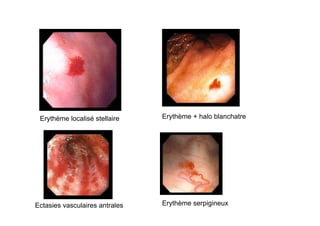 Erythème localisé stellaire    Erythème + halo blanchatre




Ectasies vasculaires antrales   Erythème serpigineux
 