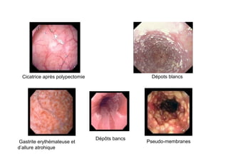 Cicatrice après polypectomie                   Dépots blancs




                                 Dépôts bancs
Gastrite erythémateuse et                       Pseudo-membranes
d’allure atrohique
 