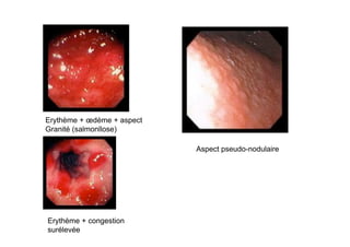 Erythème + œdème + aspect
Granité (salmonllose)

                            Aspect pseudo-nodulaire




Erythème + congestion
surélevée
 