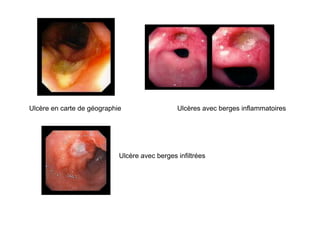 Ulcère en carte de géographie                  Ulcères avec berges inflammatoires




                            Ulcère avec berges infiltrées
 