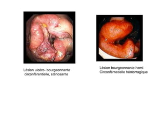 Lésion bourgeonnante hemi-
Lésion ulcéro- bourgeonnante
                                 Circonférnetielle hémorragique
 circonférentielle, sténosante
 