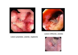 Lésion infiltrante, ulcérée
Lésion polylobée, ulcérée, végétante
 