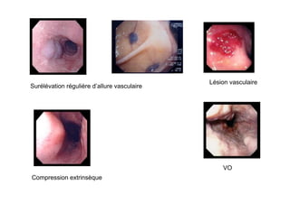 Lésion vasculaire
Surélévation régulière d’allure vasculaire




                                                 VO
Compression extrinsèque
 