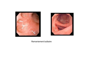 Remaniement bulbaire
 