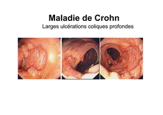 Maladie de Crohn
Larges ulcérations coliques profondes
 