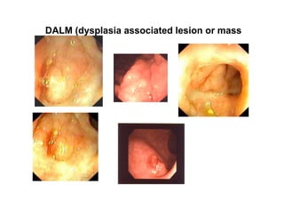 DALM (dysplasia associated lesion or mass
 