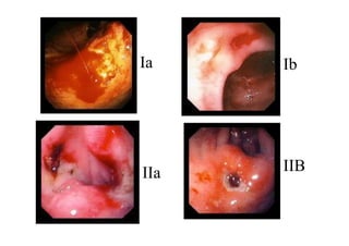 Ia    Ib




IIa   IIB
 