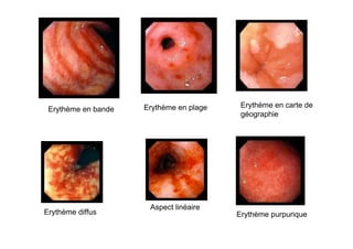Erythème en plage    Erythème en carte de
 Erythème en bande
                                          géographie




                      Aspect linéaire
Erythème diffus                          Erythème purpurique
 