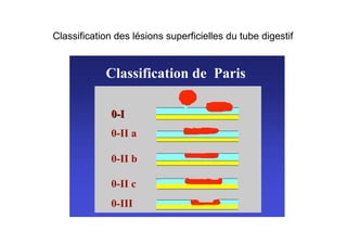 Classification des lésions superficielles du tube digestif


            Classification de Paris

              0-I
              0-II a

              0-II b

              0-II c
              0-III
 