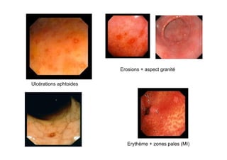 Erosions + aspect granité


Ulcérations aphtoides




                           Erythème + zones pales (MI)
 