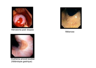 Hématome post--biopsie
                            Mélanose




Erythème arrondi localisé
(hétérotopie gastrique)
 
