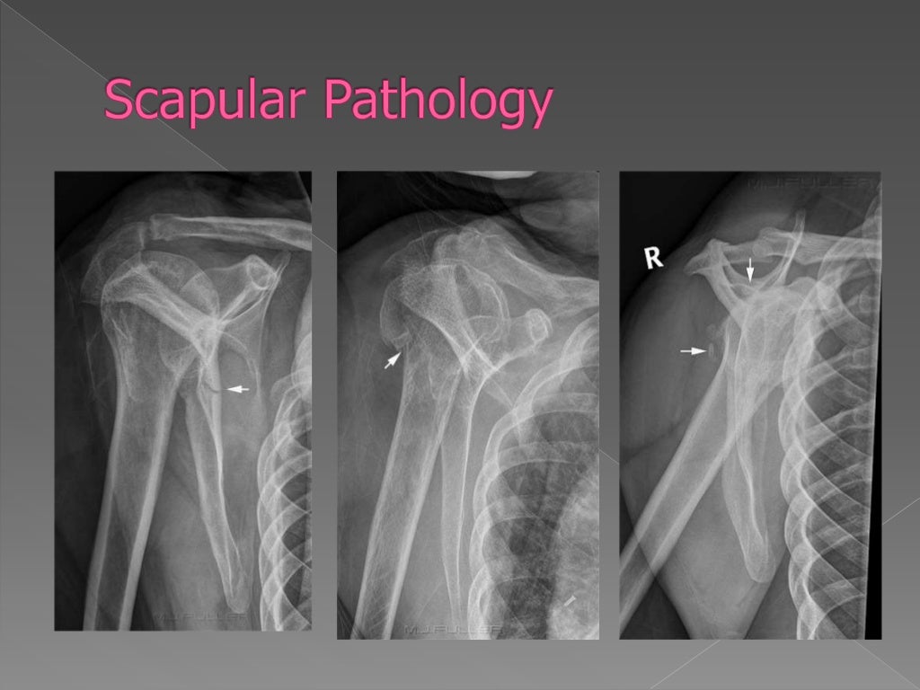 Shoulder xray