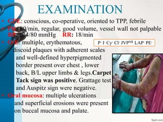 EXAMINATION 
• GPE: conscious, co-operative, oriented to TPP, febrile 
• PR: 80/min, regular, good volume, vessel wall not palpable 
BP: 124/80 mmHg RR: 18/min 
• O/E: multiple, erythematous, P- I- Cy- Cl- JVPNR LAP- PE-discoid 
plaques with adherent scales 
and well-defined hyperpigmented 
border present over chest , lower 
back, B/L upper limbs & legs.Carpet 
Tack sign was positive. Grattage test 
and Auspitz sign were negative. 
• Oral mucosa: multiple ulcerations 
and superficial erosions were present 
on buccal mucosa and palate. 
 