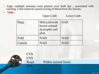 • Lips: multiple erosions were present over both lips ; associated with 
crusting. Crust removal caused oozing of blood from the lesions. 
• Nails : 
Upper Limb Lower Limb 
Plate Mild yellowish 
brown colored 
dystrophic nail 
plate 
NAD 
Fold NAD NAD 
Cuticle NAD NAD 
CVS 
CNS 
Respi. Within normal limits 
P/A 
 