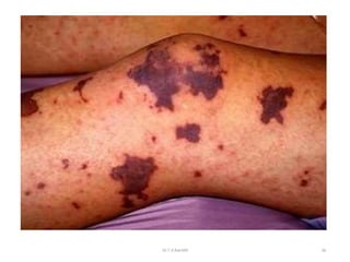 meningitis | PPTX