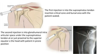 Paraspinous Injection vaishnavi.pptx