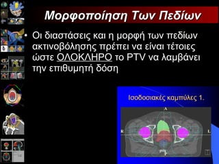 Οι διαστάσεις και η μορφή των πεδίων ακτινοβόλησης πρέπει να είναι τέτοιες ώστε  ΟΛΟΚΛΗΡΟ  το  PTV  να λαμβάνει την επιθυμητή δόση Μορφοποίηση Των Πεδίων 