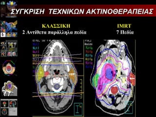ΣΥΓΚΡΙΣΗ  ΤΕΧΝΙΚΩΝ ΑΚΤΙΝΟΘΕΡΑΠΕΙΑΣ   ΚΛΑΣΣΙΚΗ   IMRT    2 Αντίθετα παράλληλα πεδία   7  Πεδία 