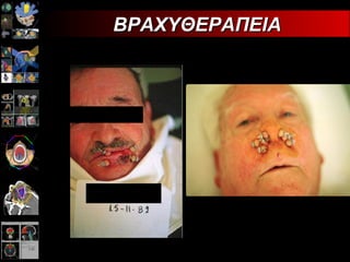 ΒΡΑΧΥΘΕΡΑΠΕΙΑ 