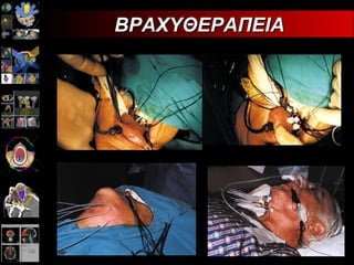 ΒΡΑΧΥΘΕΡΑΠΕΙΑ 