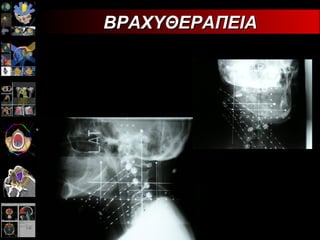 ΒΡΑΧΥΘΕΡΑΠΕΙΑ 