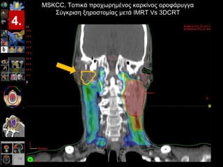Proportion (%) IMRT 3DCRT 3 DCRT IMRT Acute Late Grade    1 Grade > 1 P < 0.001 Συχνότητα ξηροστομίας μετά από >12 μήνες παρακολούθηση (IMRT = 29pts / 3DCRT = 55pts) MSKCC,  Τοπικά προχωρημένος καρκίνος οροφάρυγγα Σύγκριση ξηροστομίας μετά  IMRT Vs 3DCRT Lee et al ,  IJROBP, Nov 15, 2006 4. 34 35 65 33 67 76 24 66 