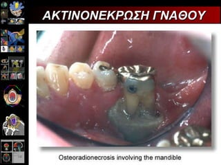 ΑΚΤΙΝΟΝΕΚΡΩΣΗ ΓΝΑΘΟΥ 