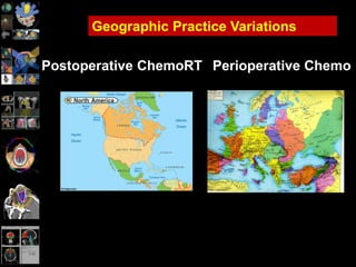 Postoperative ChemoRT
Geographic Practice Variations
Perioperative Chemo
 