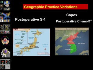 Postoperative S-1
Geographic Practice Variations
Capox
Postoperative ChemoRT
 
