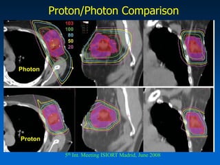 Intraoperative Radiation Therapy (IORT) for PBITARGIT trial is comparing whole breast irradiation to IORT delivering a single dose of 20 Gy. Primary accrual is in Europe.Using the Intrabeam Photon Radiosurgery System, 50 kV x-rays.Trial has enrolled 900 patients with target of 2200 patients. 
