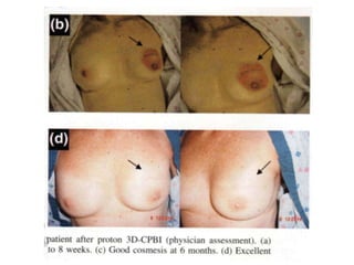 Trials of partial breast RT