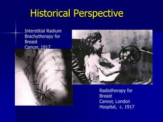 Historical PerspectiveInterstitial Radium Brachytherapy for Breast Cancer, 1917Radiotherapy for Breast Cancer, London Hospital,  c. 1917