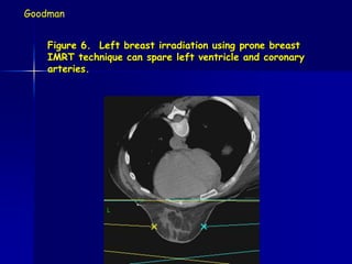 Prone Breast RT