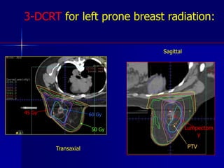GoodmanFigure 1a. Customized prone breast board with adjustable aperture and wedge for contralateral breast.Figure 1b. Ipsilateral breast and anterior chest wall hang in a dependent fashion away from the thorax while the ipsilateral arm is placed above the head