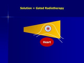 Intensity Modulated Radiotherapy (IMRT) … + Image Guidance (IGRT)Breast is a moving target !