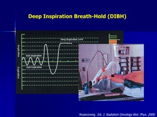 Solution = Gated RadiotherapyHeart
