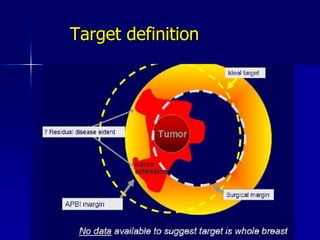 Three Established Methods For PBIMammosite®Multi Catheter3-D Conformal