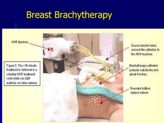 Who is eligible for PBI?	(Off study)Tumors < 3 cmNegative margins (> 2mm)Node negativeInvasive ductal carcinoma or DCISOlder women (>45 yrs)Revised Consensus Statement for Accelerated Partial Breast Irradiation, 12/8/05