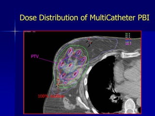 Breast Brachytherapy