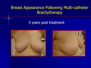 Multi-Catheter Brachytherapy