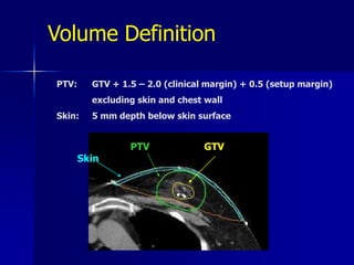 MammoSite PBIMammosite® Breast Brachytherapy ApplicatorSimplified brachytherapy 		method  for PBI