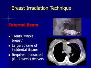  60 Gy to the lumpectomy cavity + margin