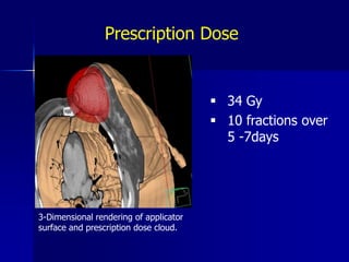   	Radiation dose prescribed to 1 	cm beyond balloon surface