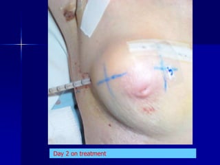     Uses 192Ir (HDR) as the source