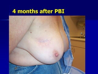 Difficulties with MammositeBalloon must conform to cavity shape without air gaps. Device explanted in ~ 10-15% of pts.Ideal is to have 7 mm b/w balloon and skin to decrease risk of erythema.Very dependent on surgical placement.