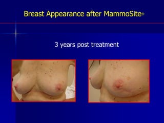 CT Planning for MammositeBrachytherapyIsodose Lines50%80%100%120%140%200%Mammosite® balloon