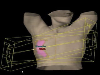1.8 – 2 Gy fraction given 5 days/ week